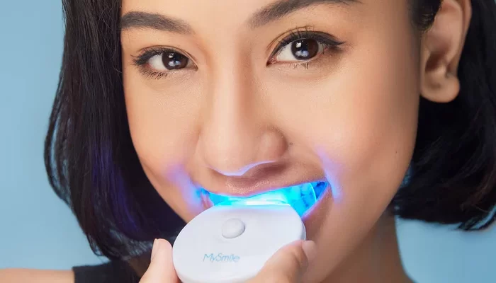 The Benefits of Over-the-Counter Teeth Whitening