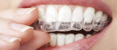Discover the Best Invisalign Dentist in Plantation, FL – A Hidden Gem!