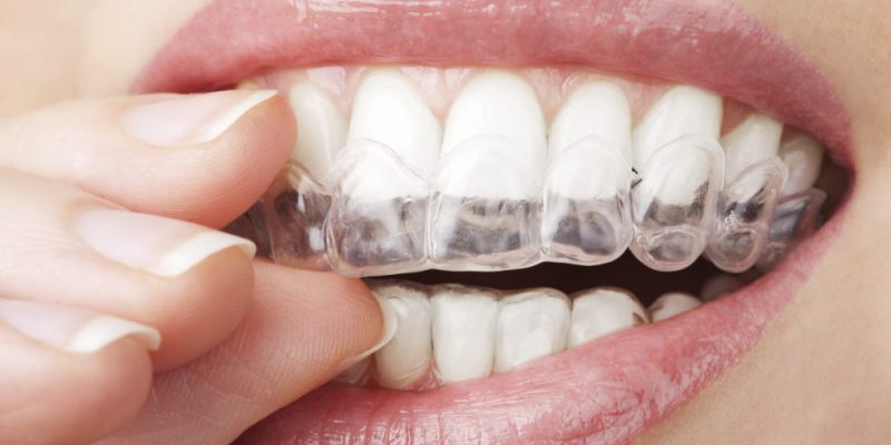 Discover the Best Invisalign Dentist in Plantation, FL – A Hidden Gem!