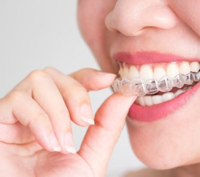 Unveiling the Perfect Smile: V Smile Family Dental – Your Expert Invisalign Dentist in Texas