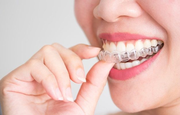 Invisalign Near Me: Finding Your Perfect Provider