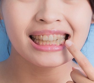 Removing Tobacco Stains from Teeth