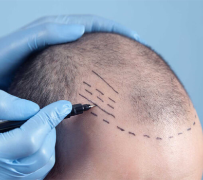 Comparing the Best Hair Transplant Clinics in London & Beyond