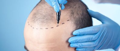 Why London Is Becoming the Hub for Advanced Hair Transplant Procedures