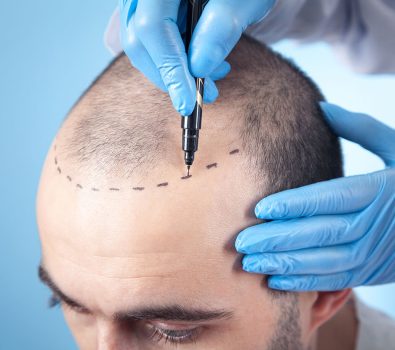 Why London Is Becoming the Hub for Advanced Hair Transplant Procedures