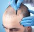 Why London Is Becoming the Hub for Advanced Hair Transplant Procedures