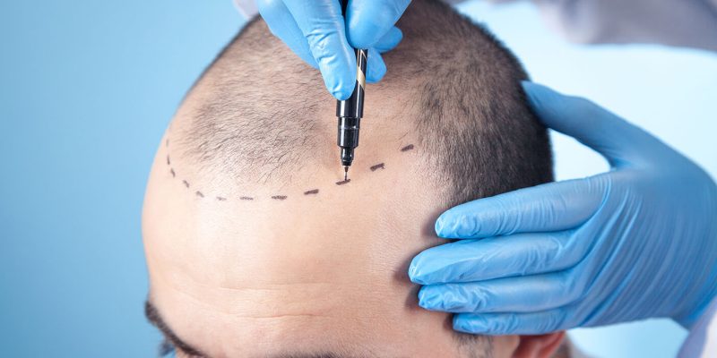 Why London Is Becoming the Hub for Advanced Hair Transplant Procedures