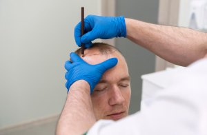 The Real Hair Transplant Cost in London: What Patients Should Expect