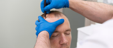The Real Hair Transplant Cost in London: What Patients Should Expect