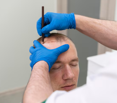 The Real Hair Transplant Cost in London: What Patients Should Expect The Real Hair Transplant Cost in London: What Patients Should Expect